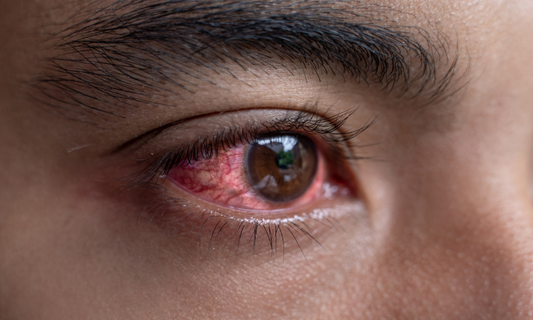 Why Are My Eyes Itchy and Watery? Allergic Conjunctivitis Explained